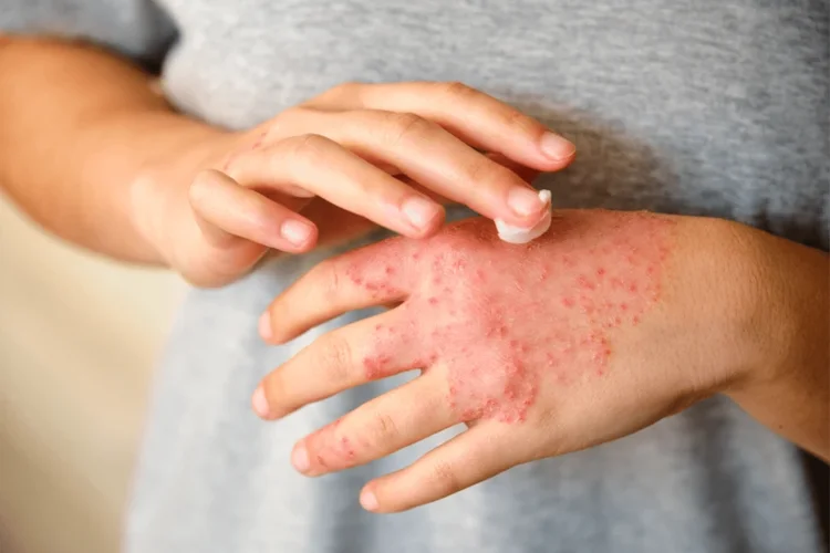 Como o estresse desencadeia crises de eczema?