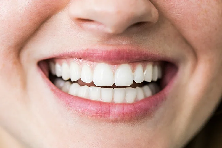 Dentes brancos? Nem sempre é sinal de saúde bucal
