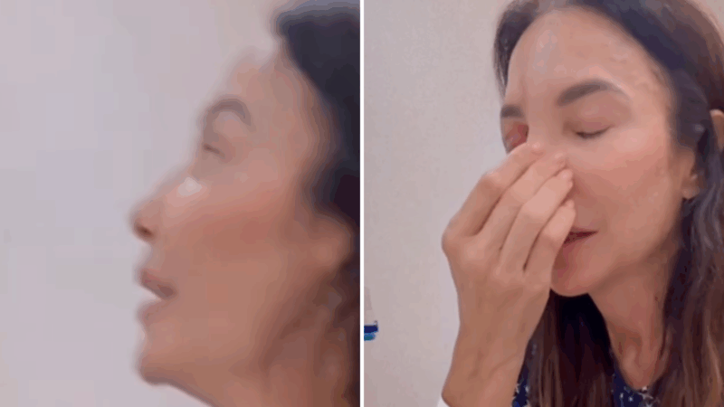 Desfigurada, Ivete Sangalo fala sobre cirurgia no rosto e web se impressiona: ‘Essa história tá estranha’