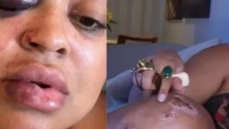 Ex-BBB mostra machucados no  rosto após sofrer acidente de trânsito