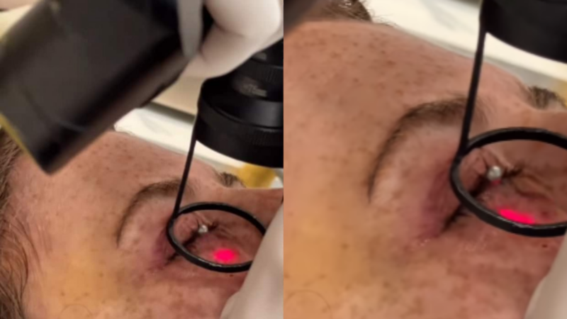 Famosa retira tumores abaixo dos olhos e desabafa: ‘Medo’
