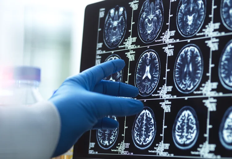 IA ajuda cientistas a descobrir sinais precoces de demência