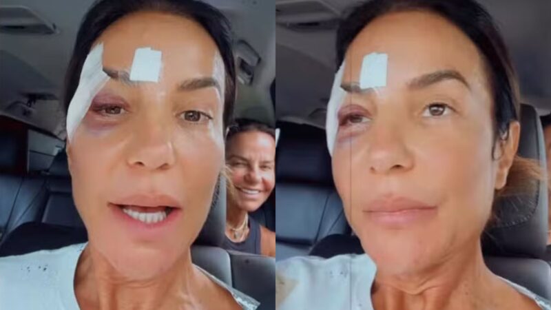 Ivete Sangalo recebe alta após desmaio e ferimentos no rosto