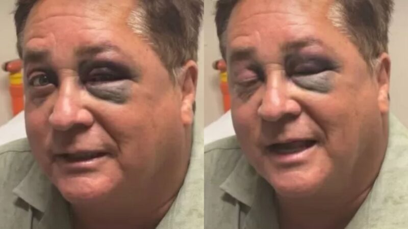 Leonardo surge com ferimento no rosto e revela o que aconteceu no Pantanal; saiba tudo