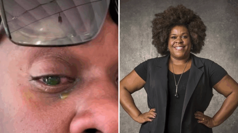 Médicos fazem alerta sobre produto que causou grave perda de visão em Cacau Protásio