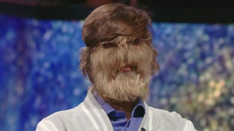 ‘Síndrome do lobisomem’: Homem com 95% do rosto coberto por pelos vira fenômeno na web